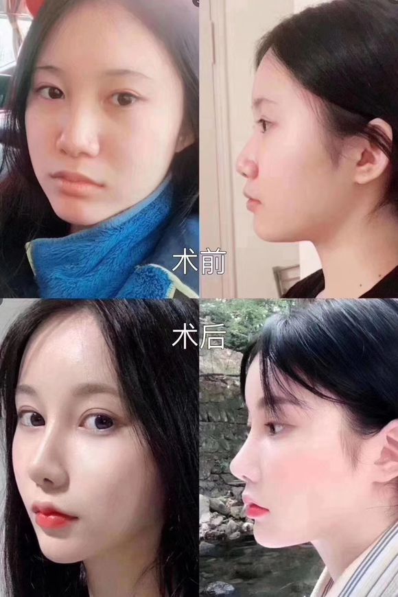 为什么做鼻子的人越来越多？因为做了鼻子之后真的超美怎么拍照怎-2.jpg